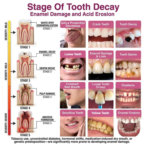 Cavity-Repair Natural Enamel Filling Gel